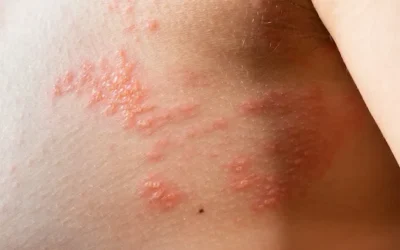 Tudo que você precisa saber sobre a Esporotricose